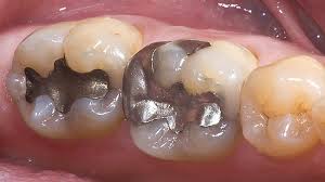 ترمیم با مواد غیر همرنگ دندان-درمانگاه دندانپزشکی آپادانا