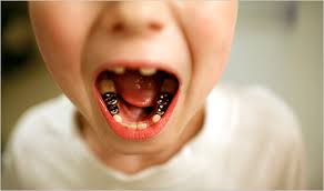 فضای نگهدار دندان در درمانگاه دندانپزشکی آپادانا