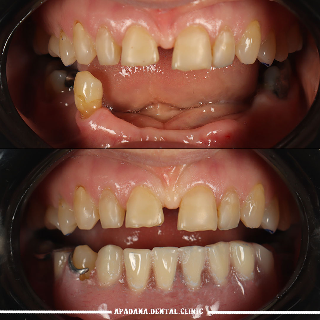 پروتز ثابت و متحرک در درمانگاه دندانپزشکی آپادانا