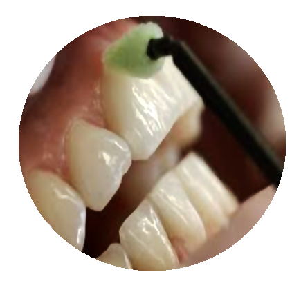 فلوراید تراپی با وارنیش یکی دیگر از روشهای درمان در کلینیک دندانپزشکی آپادانا رشت