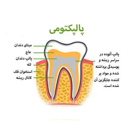 پالپکتومی در درمانگاه دندانپزشکی آپادانا