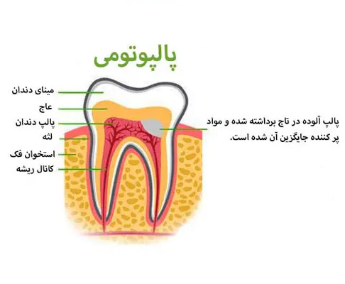 عکس دندان پالپتومی-درمانگاه دندانپزشکی آپادانا