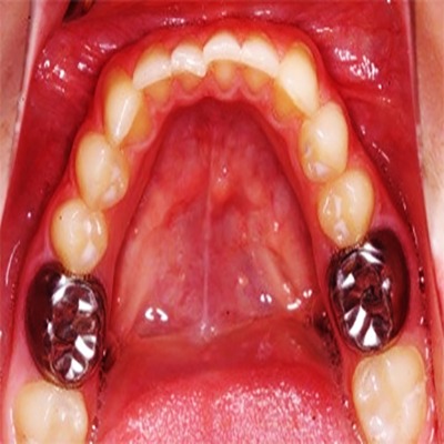 روکش روی دندان شیری SSC در کلینیک دندانپزشکی آپادانا رشت