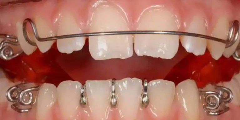 ارتودنسی متحرک در کلینیک دندانپزشکی آپادانا رشت